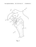 Joint Prosthesis having Infinitely Adjustable Head diagram and image