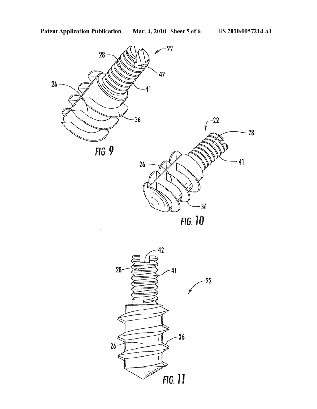 ARTHRODESIS IMPLANT FOR FINGER JOINTS AND RELATED METHODS - diagram, schematic, and image 06