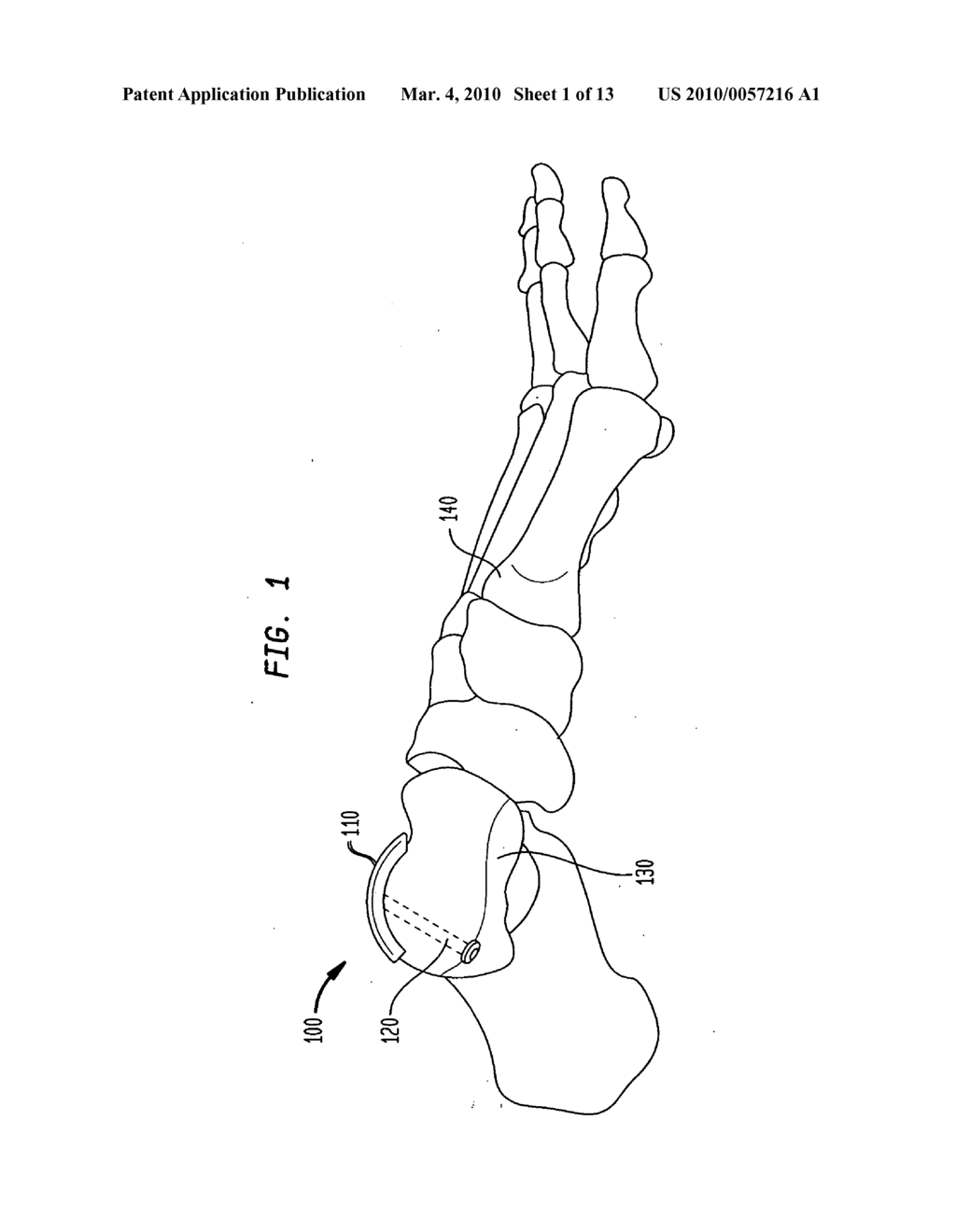 System and method for joint resurfacing with dynamic fixation - diagram, schematic, and image 02