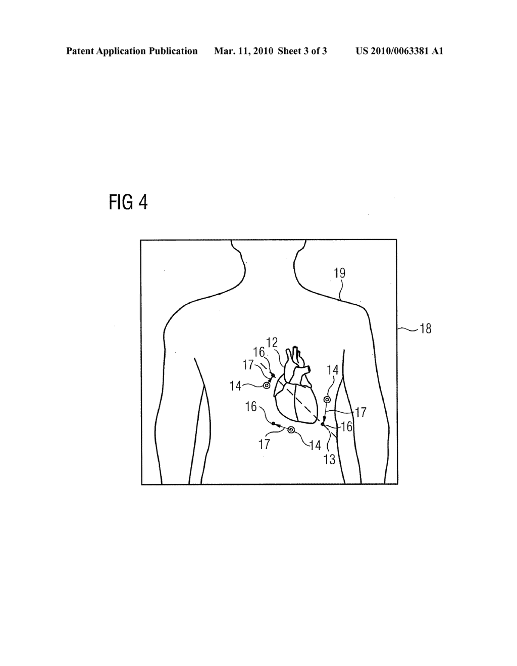 METHOD FOR DETERMINING AN ITEM OF POSITIONING INFORMATION FOR ECG ELECTRODES DURING AN EXAMINATION WITH A MAGNETIC RESONANCE FACILITY AND MAGNETIC RESONANCE FACILITY - diagram, schematic, and image 04