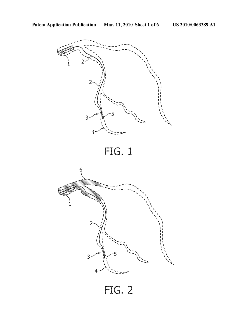 METHOD AND DEVICE FOR RECORDING A VASCULAR STRUTURE DURING INTERVENTION - diagram, schematic, and image 02