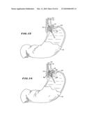 SYSTEM FOR TISSUE ABLATION diagram and image