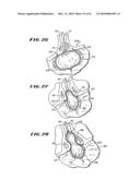 SYSTEM FOR TISSUE ABLATION diagram and image