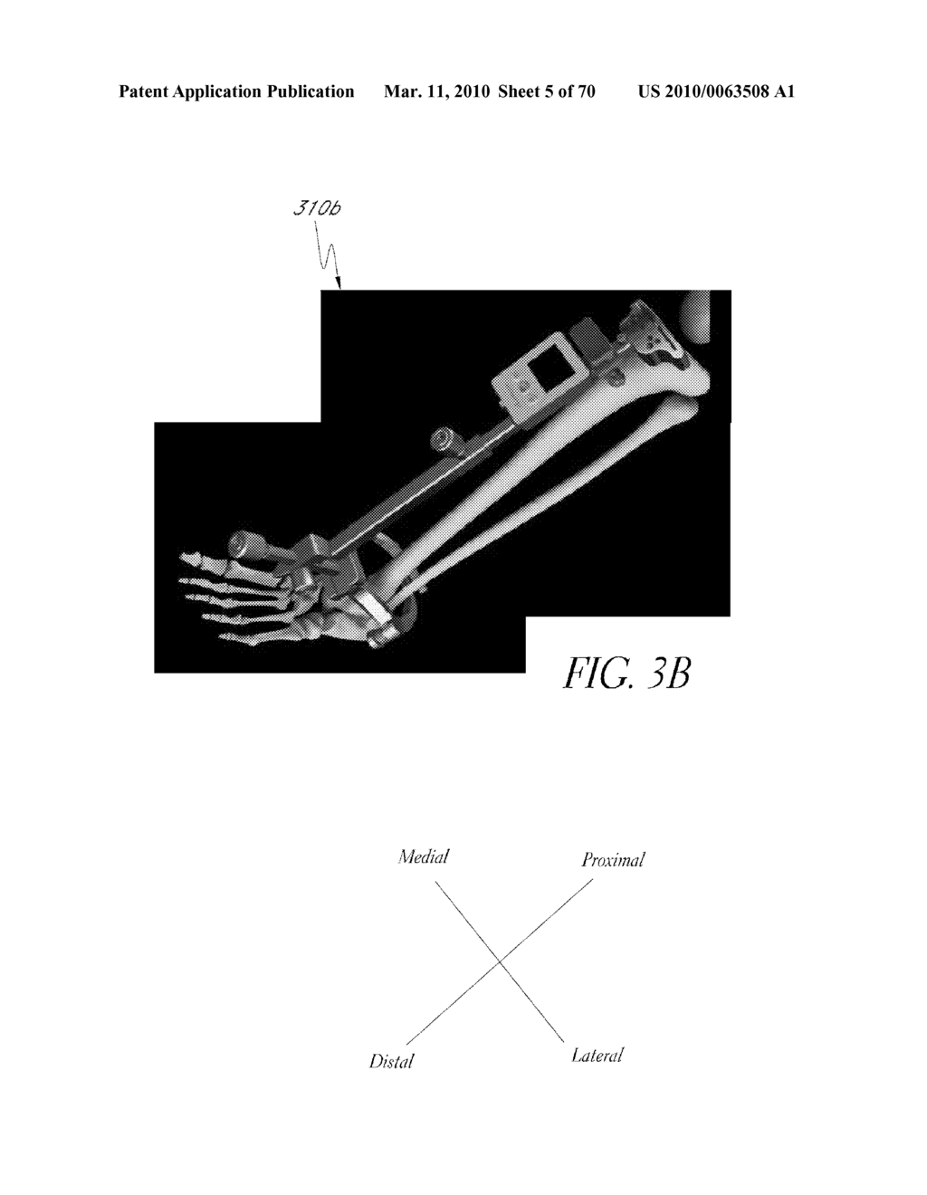 SYSTEMS AND METHODS FOR JOINT REPLACEMENT - diagram, schematic, and image 06