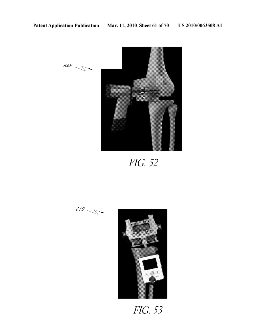 SYSTEMS AND METHODS FOR JOINT REPLACEMENT - diagram, schematic, and image 62
