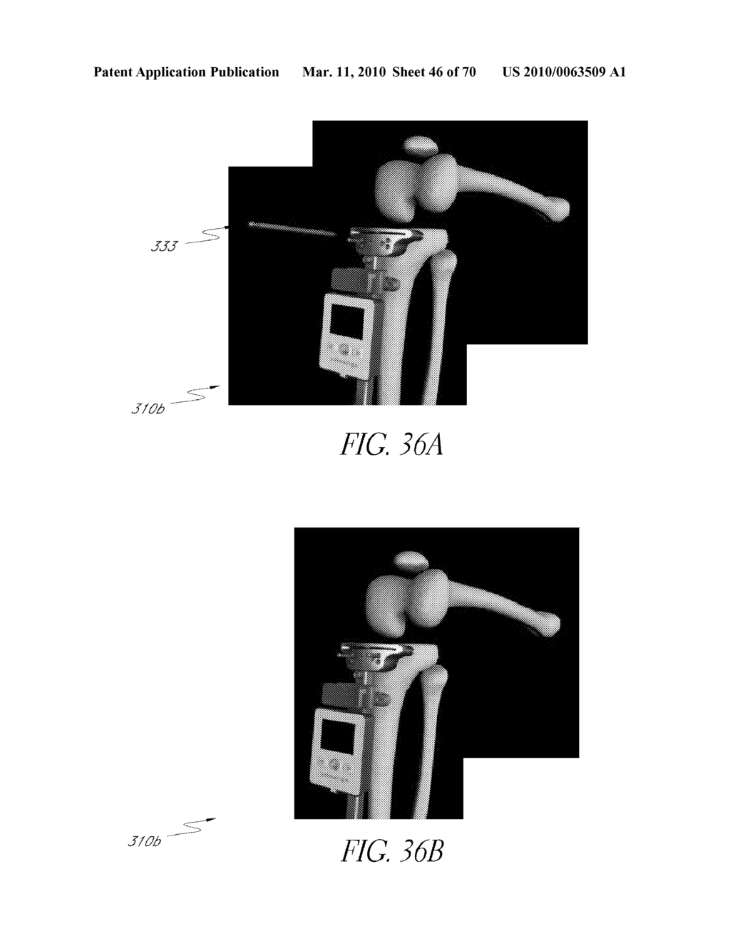 SYSTEMS AND METHODS FOR JOINT REPLACEMENT - diagram, schematic, and image 47