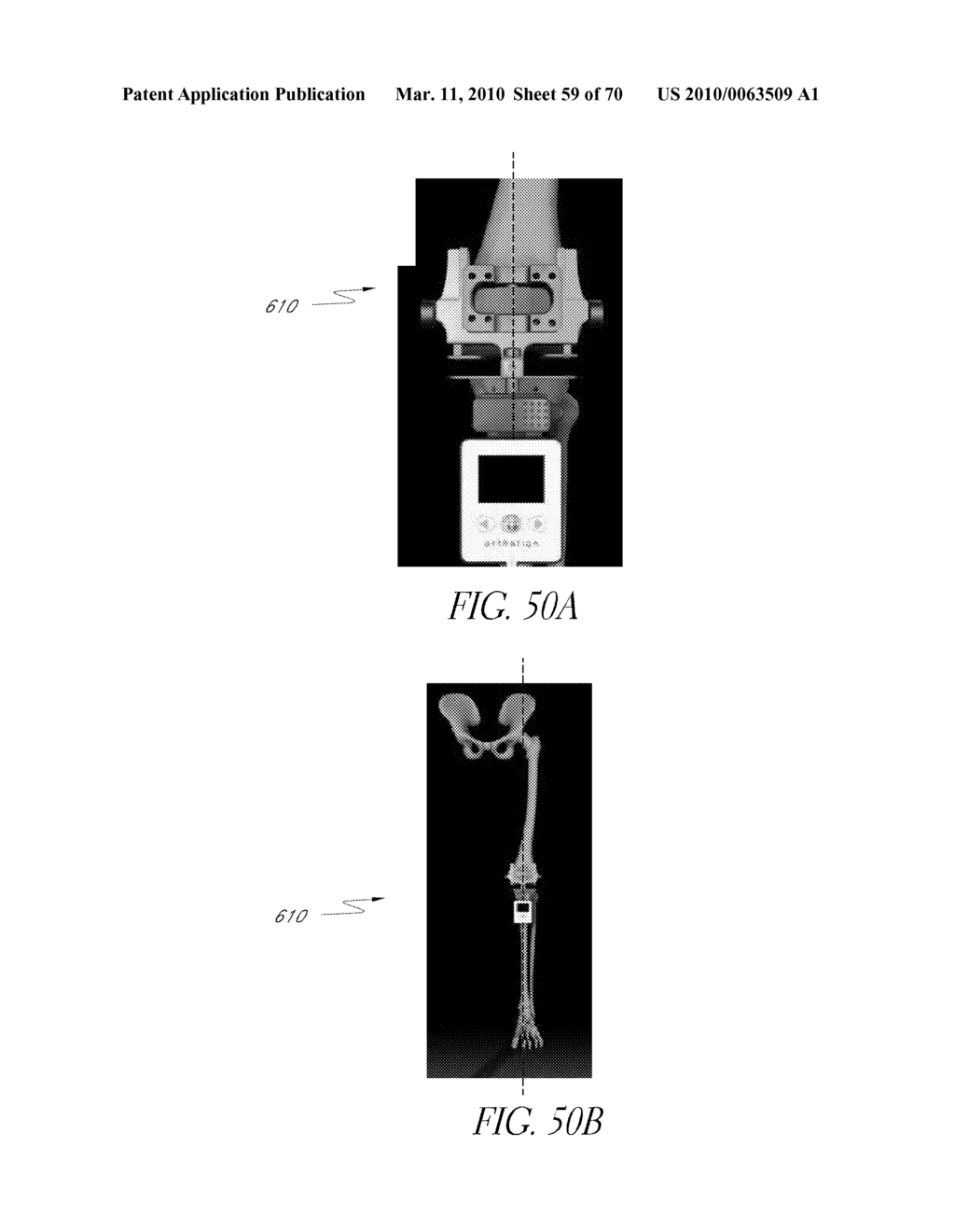 SYSTEMS AND METHODS FOR JOINT REPLACEMENT - diagram, schematic, and image 60