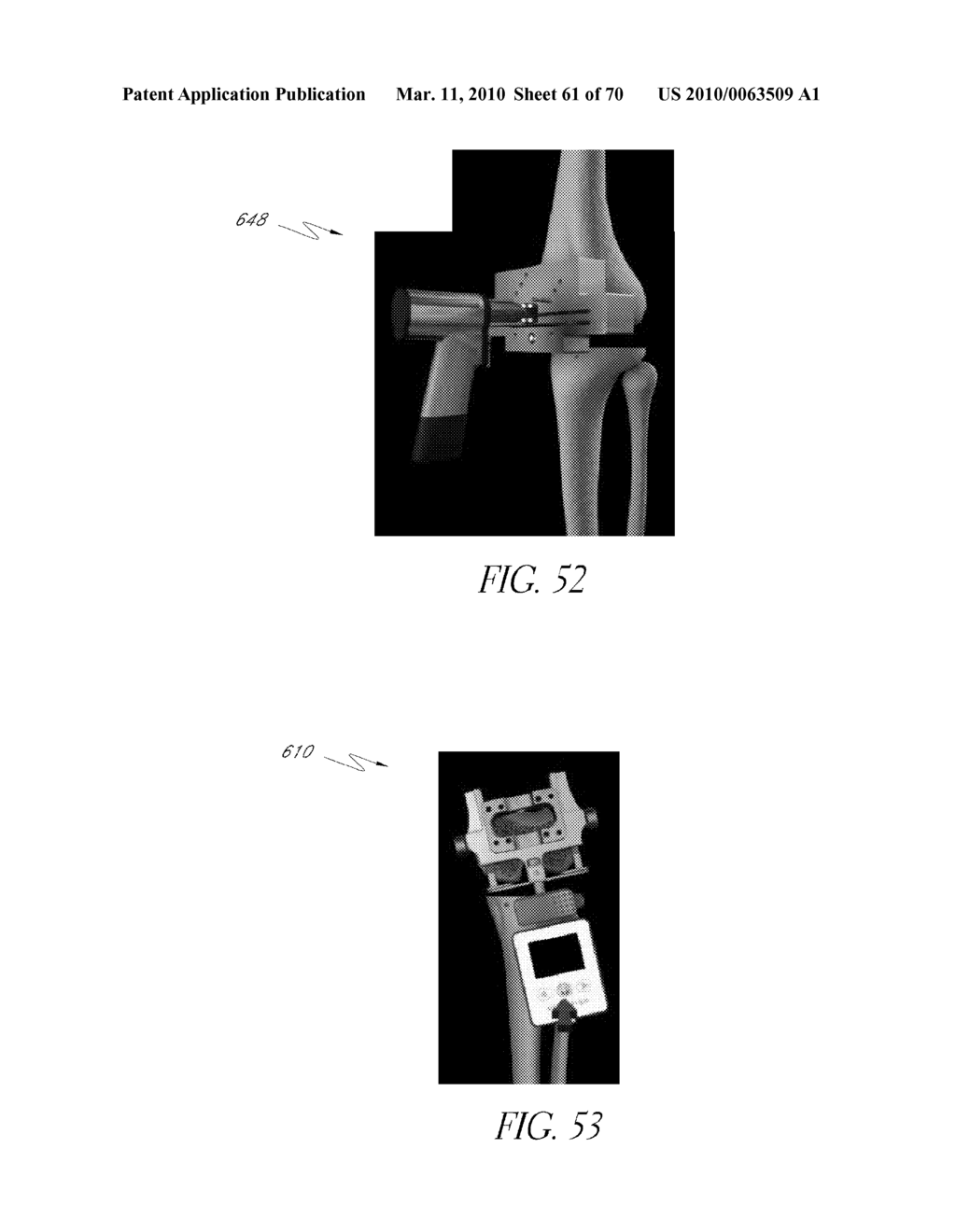 SYSTEMS AND METHODS FOR JOINT REPLACEMENT - diagram, schematic, and image 62