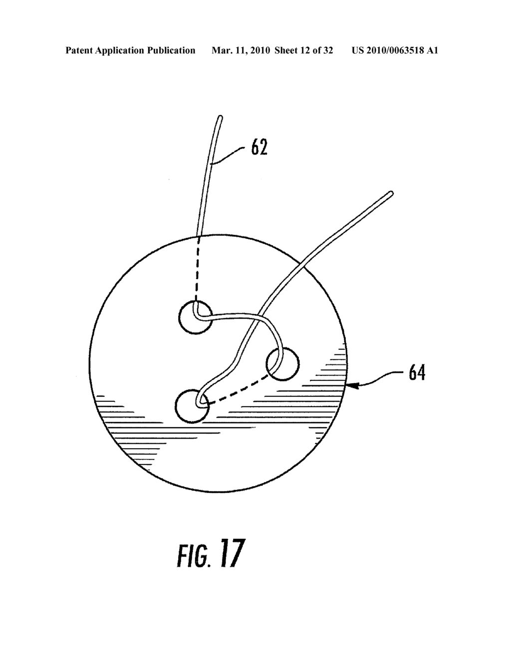 MEDICAL DEVICE FIXATION TOOL AND METHOD OF FIXATION OF A MEDICAL DEVICE - diagram, schematic, and image 13