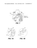 ENDOVASCULAR DEVICES AND METHODS FOR EXPLOITING INTRAMURAL SPACE diagram and image