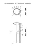 ENDOVASCULAR DEVICES AND METHODS FOR EXPLOITING INTRAMURAL SPACE diagram and image