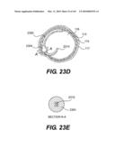 ENDOVASCULAR DEVICES AND METHODS FOR EXPLOITING INTRAMURAL SPACE diagram and image