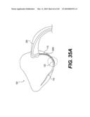 ENDOVASCULAR DEVICES AND METHODS FOR EXPLOITING INTRAMURAL SPACE diagram and image