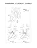 METHOD OF REMOVING A VEIN FILTER diagram and image