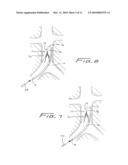 METHOD OF REMOVING A VEIN FILTER diagram and image