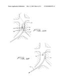 METHOD OF REMOVING A VEIN FILTER diagram and image