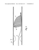 DOUBLE ENDED INTRAVASCULAR MEDICAL DEVICE diagram and image