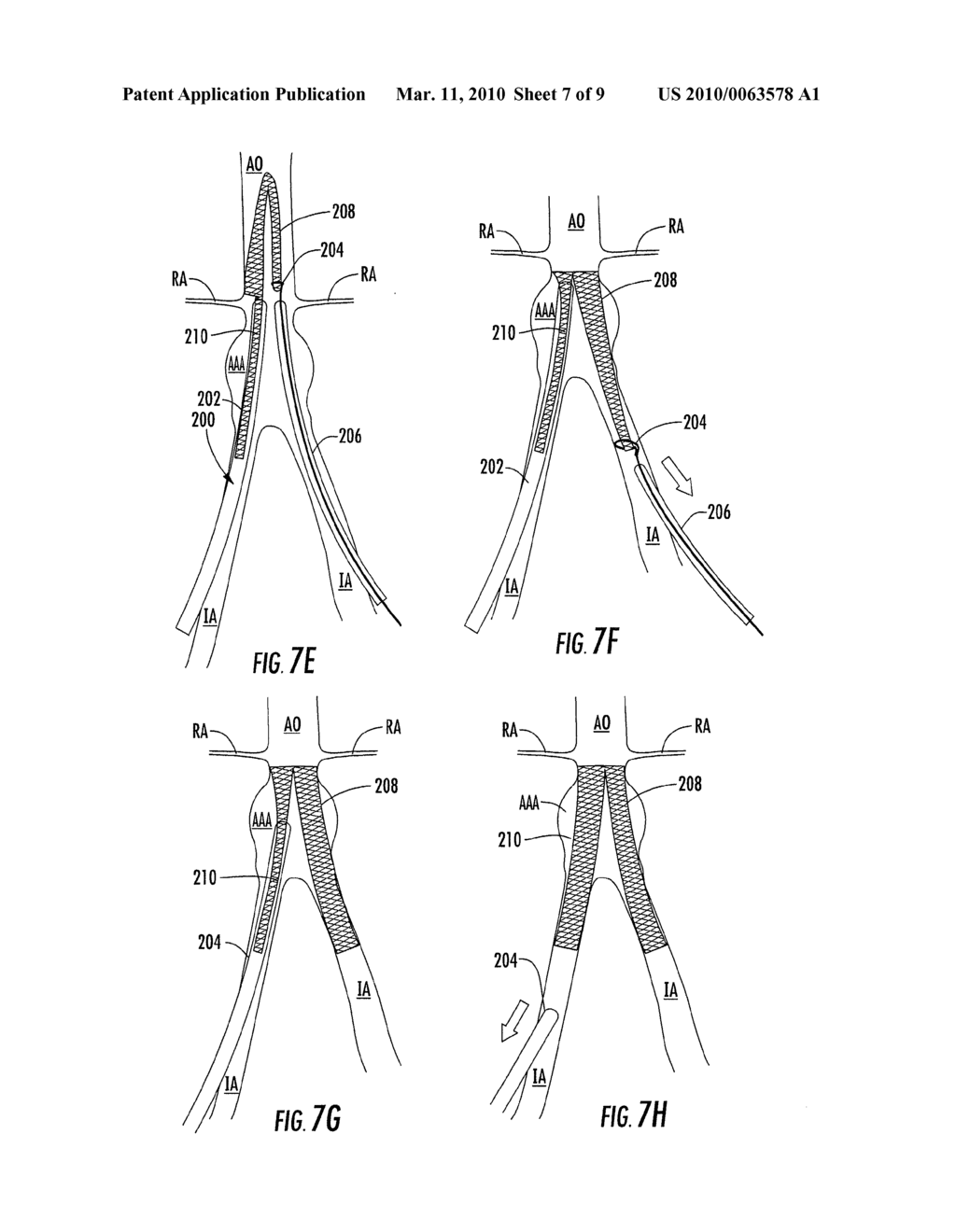 BIFURCATED MEDICAL DEVICE FOR TREATING A TARGET SITE AND ASSOCIATED METHOD - diagram, schematic, and image 08