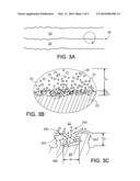 ENDOPROSTHESES diagram and image