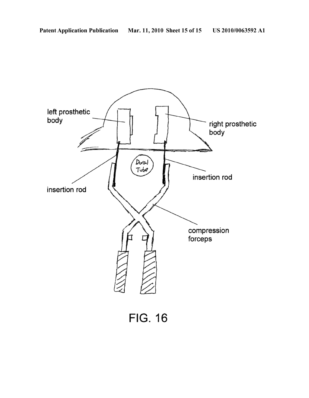 INTERLOCKING MULTI-PIECE INTERVERTEBRAL DISC PROSTHESIS AND METHOD FOR IMPLANTING SAME - diagram, schematic, and image 16