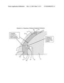 SHOULDER JOINT IMPLANT diagram and image