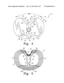 FIXED-BEARING KNEE PROSTHESIS HAVING INTERCHANGEABLE COMPONENTS diagram and image