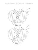 FIXED-BEARING KNEE PROSTHESIS HAVING INTERCHANGEABLE COMPONENTS diagram and image