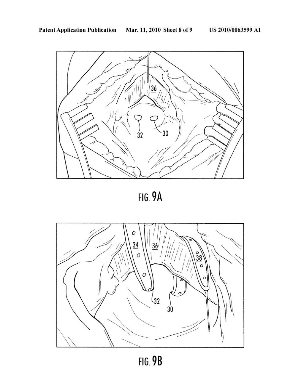 DEVICE FOR SOFT TISSUE REPAIR OR REPLACEMENT - diagram, schematic, and image 09