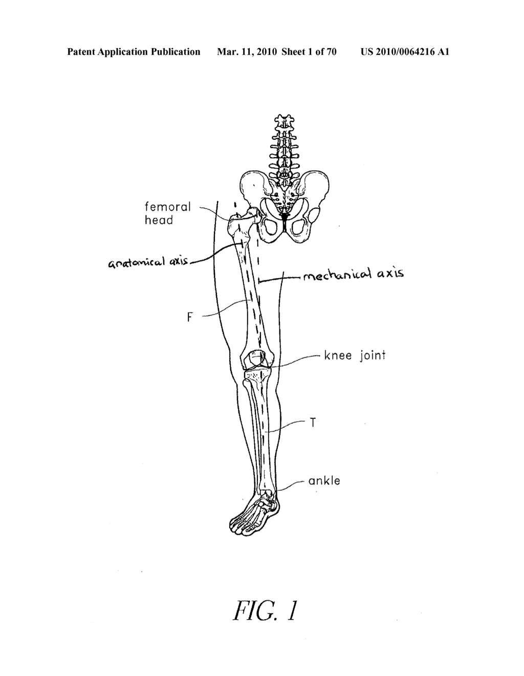 SYSTEMS AND METHODS FOR JOINT REPLACEMENT - diagram, schematic, and image 02