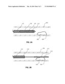 LOCAL DELIVERY OF WATER-SOLUBLE OR WATER-INSOLUBLE THERAPEUTIC AGENTS TO THE SURFACE OF BODY LUMENS diagram and image