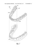 Dental appliance with resilient portion diagram and image