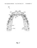 Dental appliance with resilient portion diagram and image