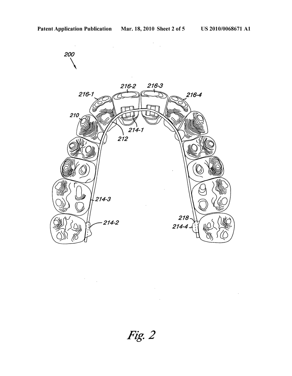 Dental appliance with resilient portion - diagram, schematic, and image 03