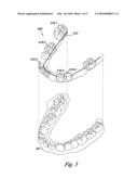 Dental appliance with resilient portion diagram and image