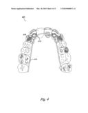 Dental appliance with resilient portion diagram and image