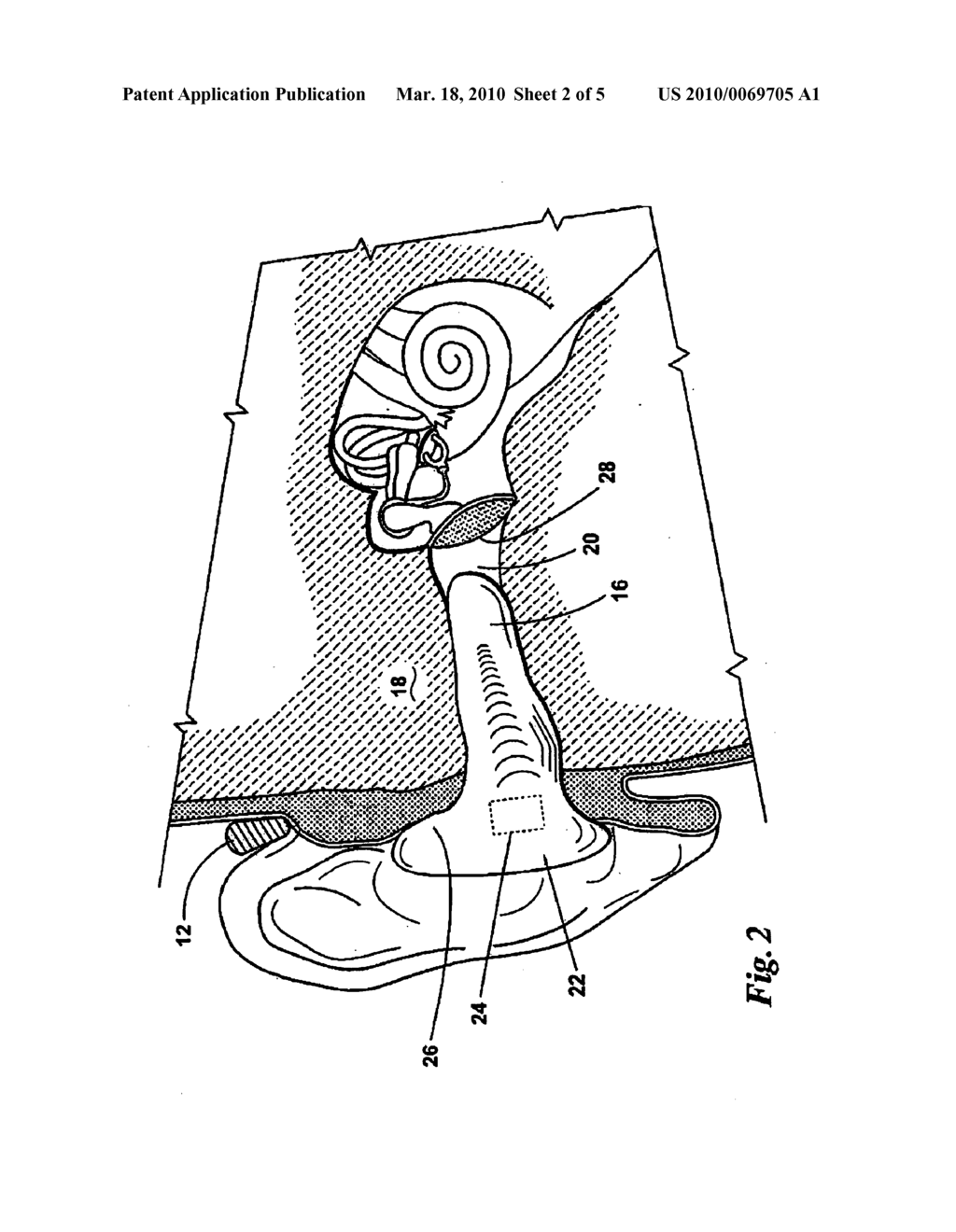 HEARING ASSISTANCE DEVICE HAVING REDUCED MECHANICAL FEEDBACK - diagram, schematic, and image 03