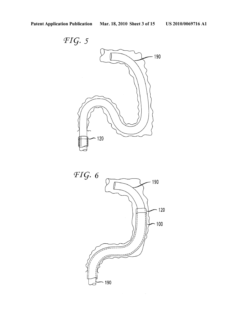 FLEXIBLE GUIDE CONDUIT - diagram, schematic, and image 04