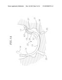 CATHETER WITH FLEXIBLE PRE-SHAPED TIP SECTION diagram and image