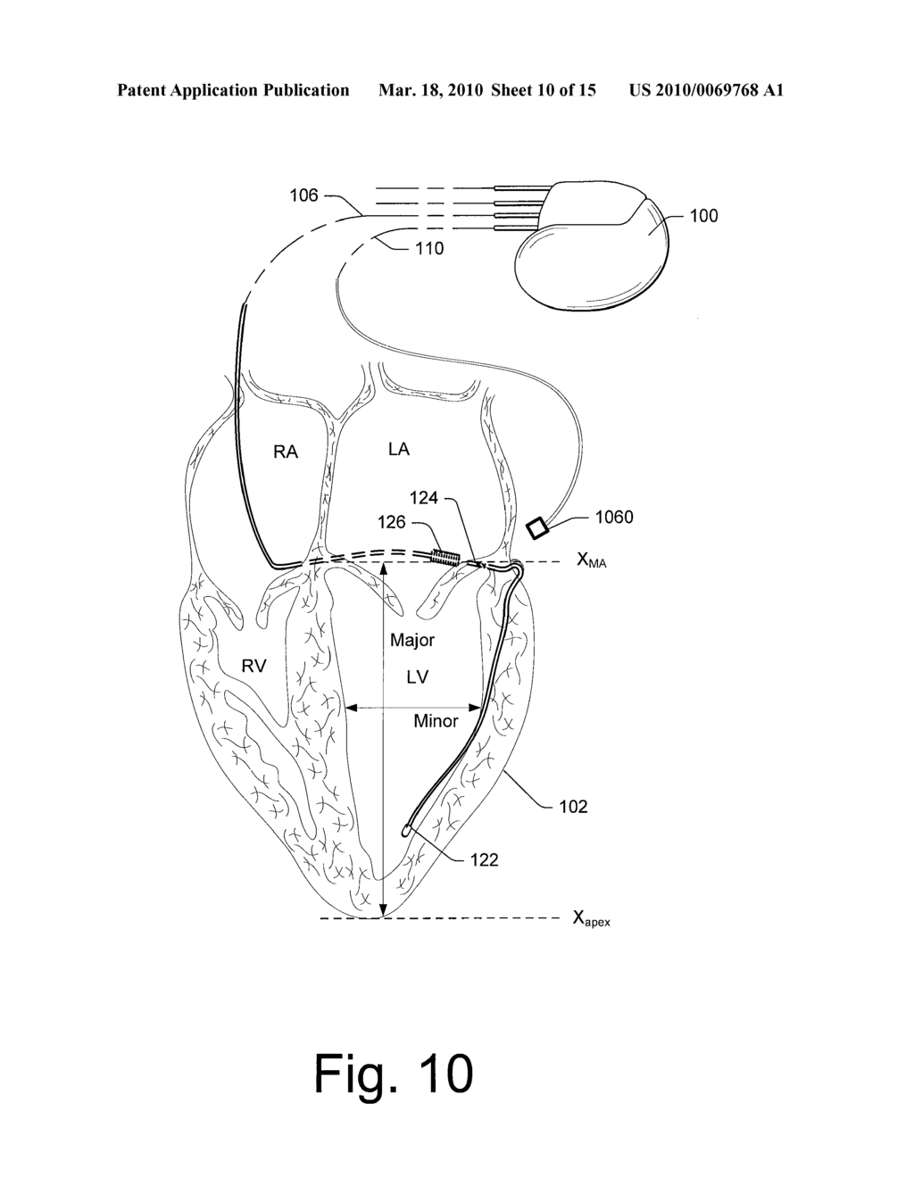 USE OF CARDIOHEMIC VIBRATION FOR PACING THERAPIES - diagram, schematic, and image 11