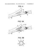 PLAQUE LIBERATING DEVICE diagram and image