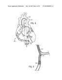 CATHETER SYSTEM diagram and image