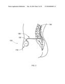 DETERMINING CATHETER STATUS diagram and image