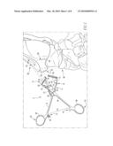 Osteotomy Guide and Method of Cutting the Medial Distal Tibia Employing the Same diagram and image