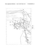 Osteotomy Guide and Method of Cutting the Medial Distal Tibia Employing the Same diagram and image