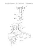 Osteotomy Guide and Method of Cutting the Medial Distal Tibia Employing the Same diagram and image