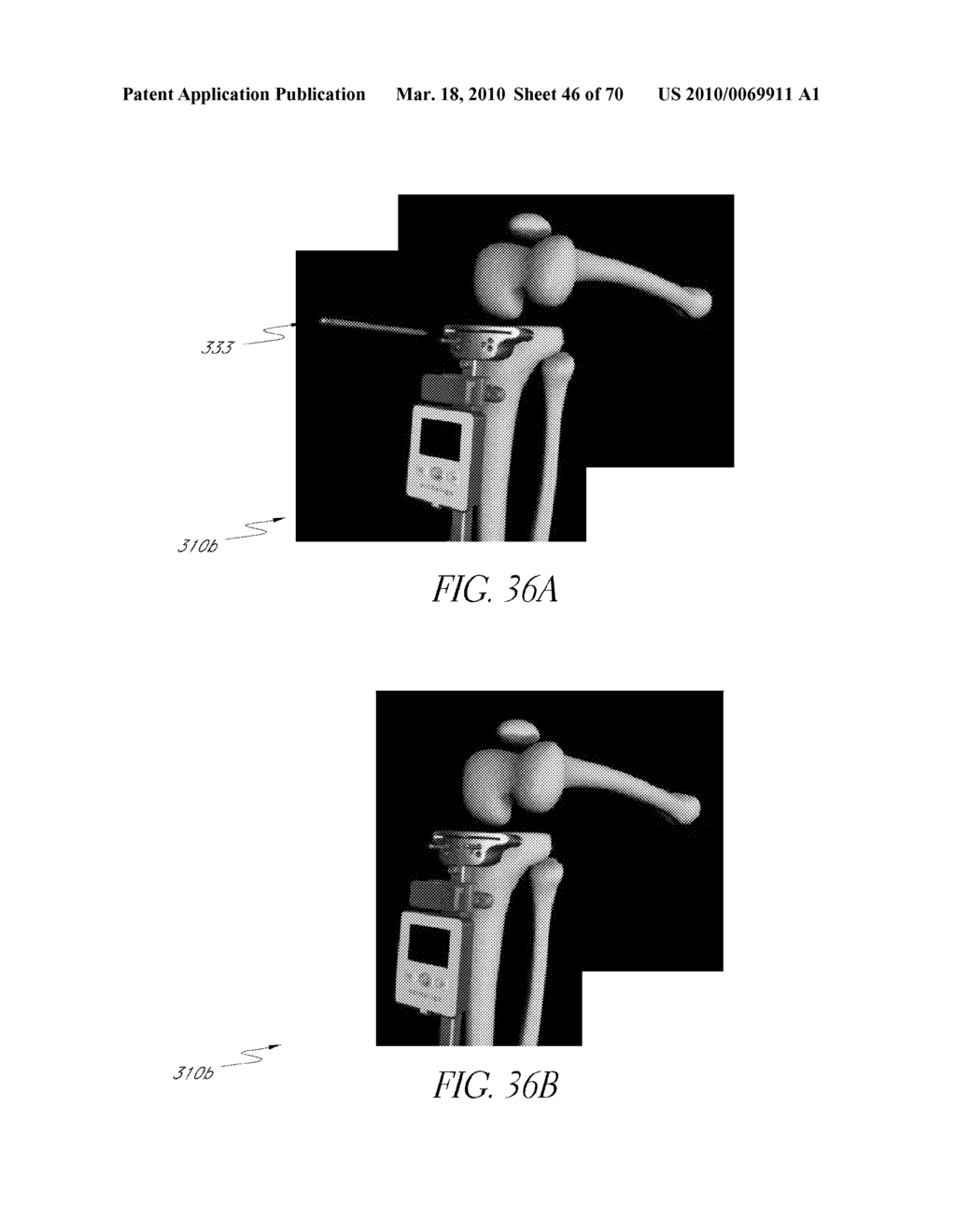 SYSTEMS AND METHODS FOR JOINT REPLACEMENT - diagram, schematic, and image 47