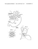 Transesophageal gastric reduction method and device for reducing the size of a previously formed gastric reduction pouch diagram and image
