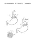 Transesophageal gastric reduction method and device for reducing the size of a previously formed gastric reduction pouch diagram and image