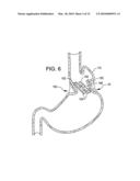 Transesophageal gastric reduction method and device for reducing the size of a previously formed gastric reduction pouch diagram and image