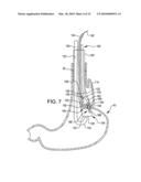 Transesophageal gastric reduction method and device for reducing the size of a previously formed gastric reduction pouch diagram and image